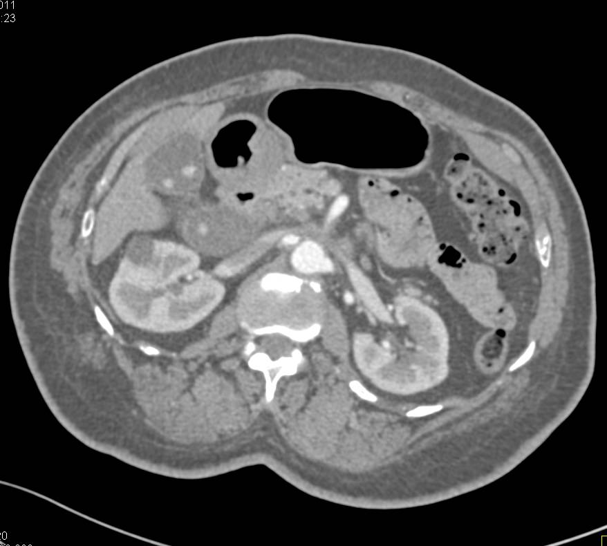 Acute Cholecystitis - CTisus CT Scan