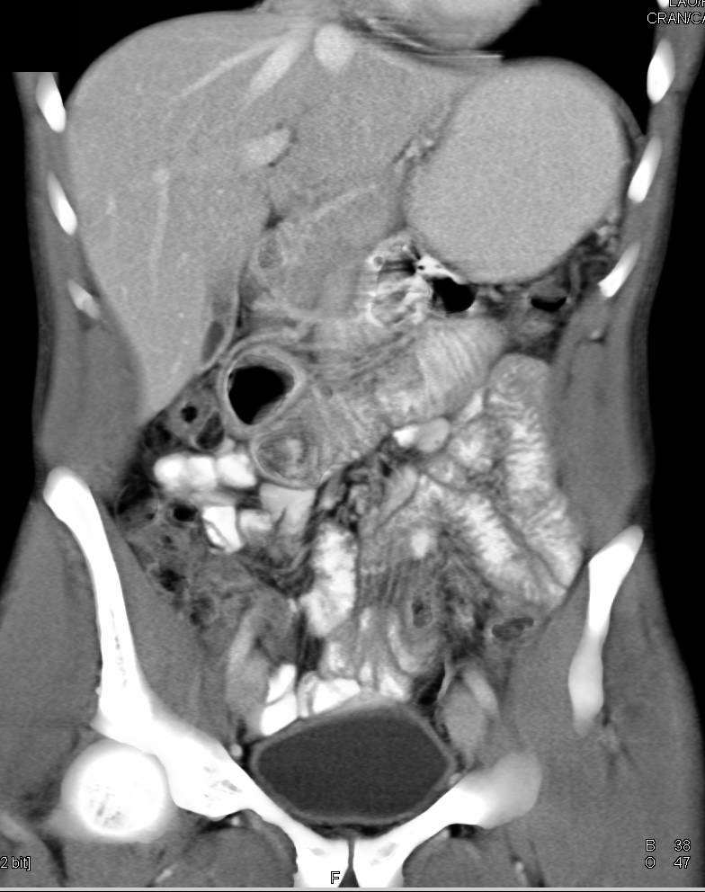 Sprue Small Bowel - CTisus CT Scan