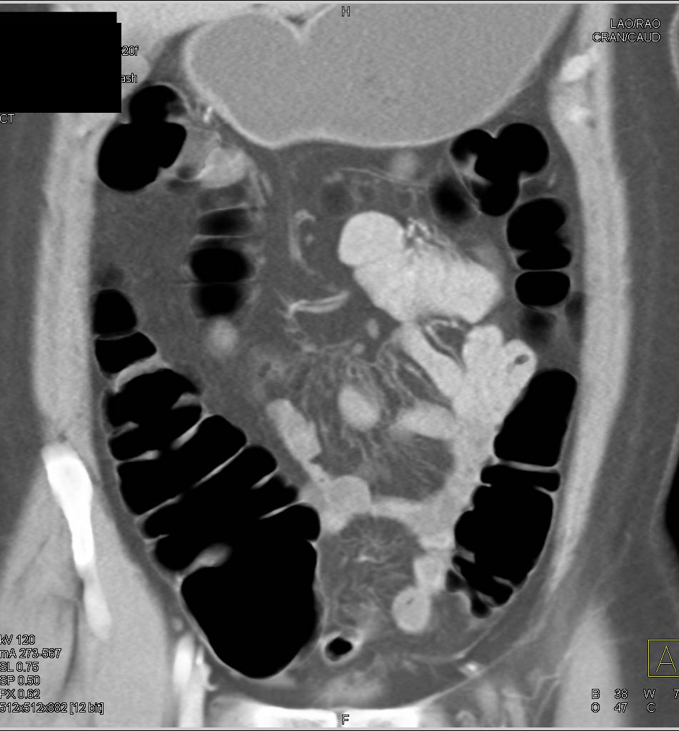 CTA with Normal Colon - CTisus CT Scan