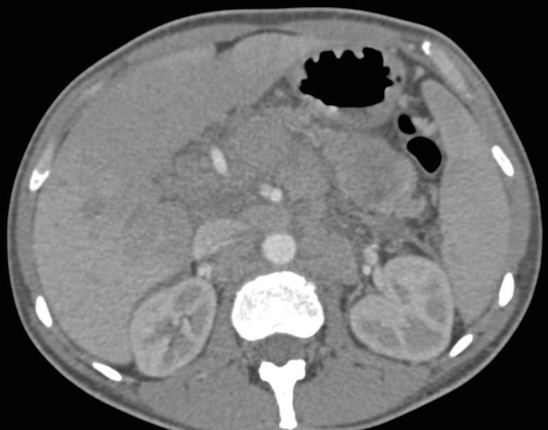 Cholangiocarcinoma with Bulky Para-aortic Adenopathy - CTisus CT Scan