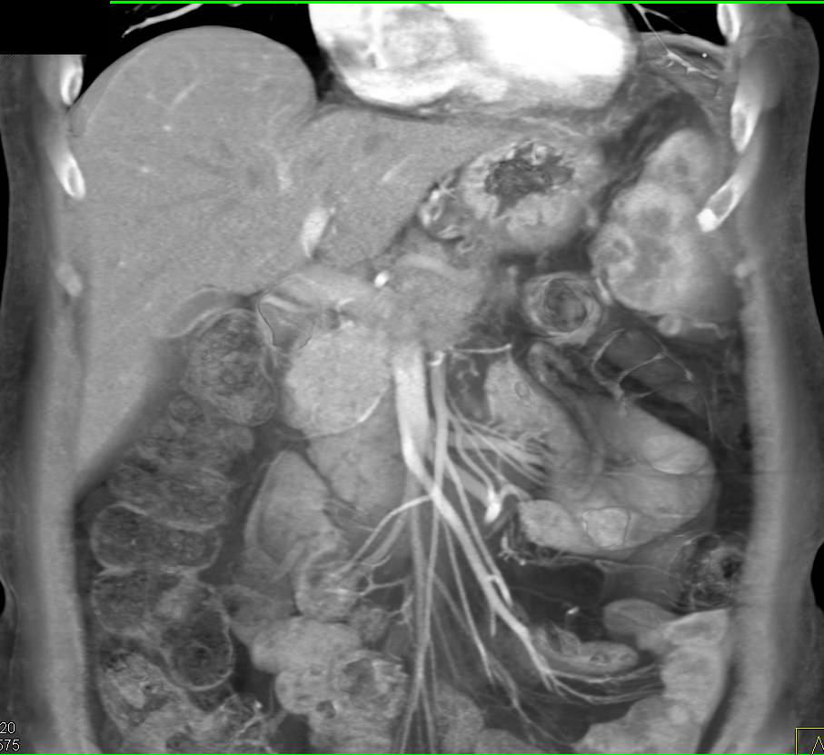 Lymphoma with Peripancreatic Adenopathy - CTisus CT Scan