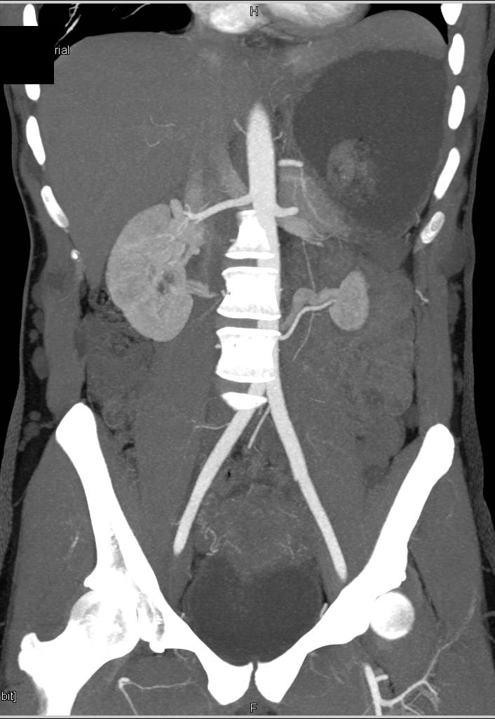 Neurofibromatosis - CTisus CT Scan