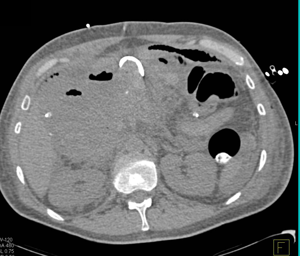 Active Bleed in the Right Lower Quadrant with CTA - CTisus CT Scan