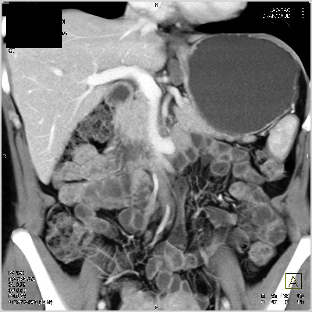 Celiac Adenopathy - CTisus CT Scan