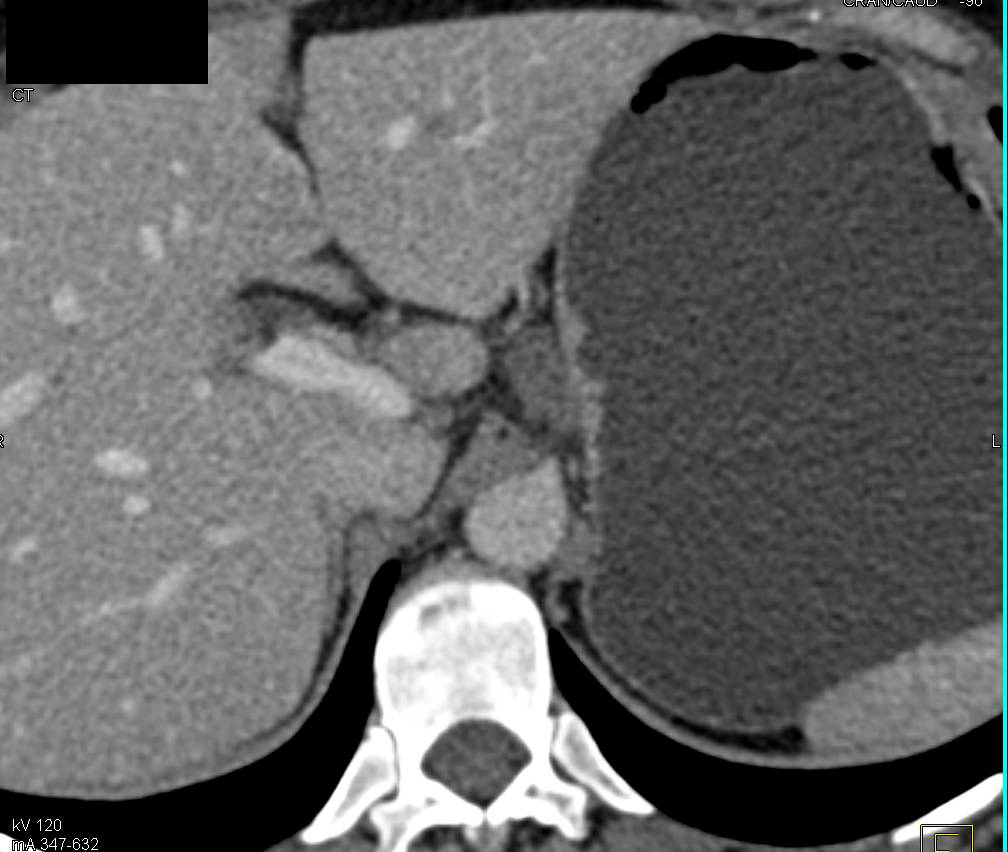 Celiac Adenopathy (small) - CTisus CT Scan