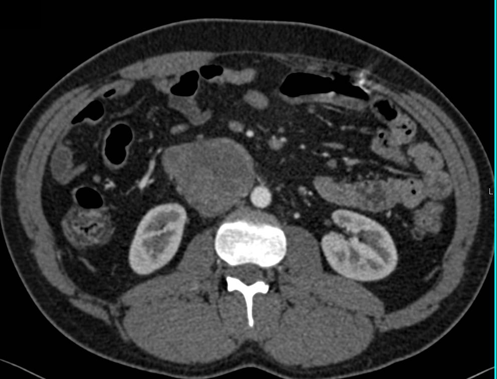 Germ Cell Tumor Presents as a Para-aortic Peripancreatic Mass - CTisus CT Scan