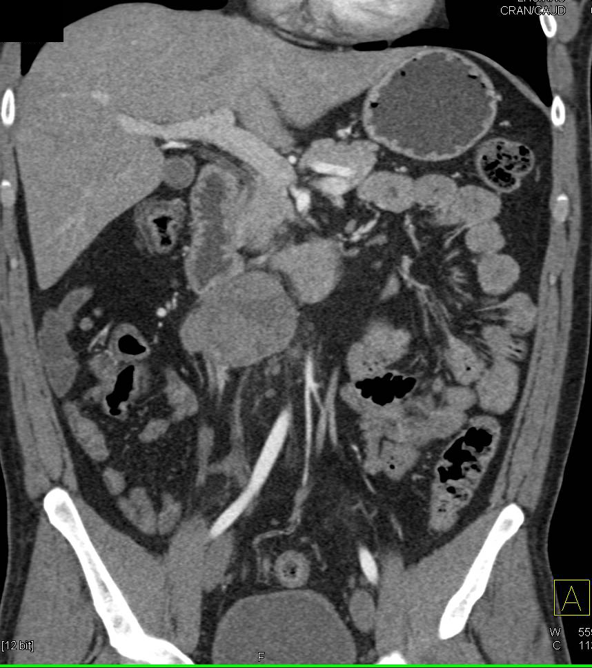 Para-aortic Mass due to Germ Cell Tumor - CTisus CT Scan