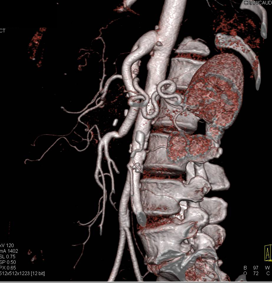 Reimplanted Celiac and Superior Mesenteric Artery (SMA) in 3D - CTisus CT Scan