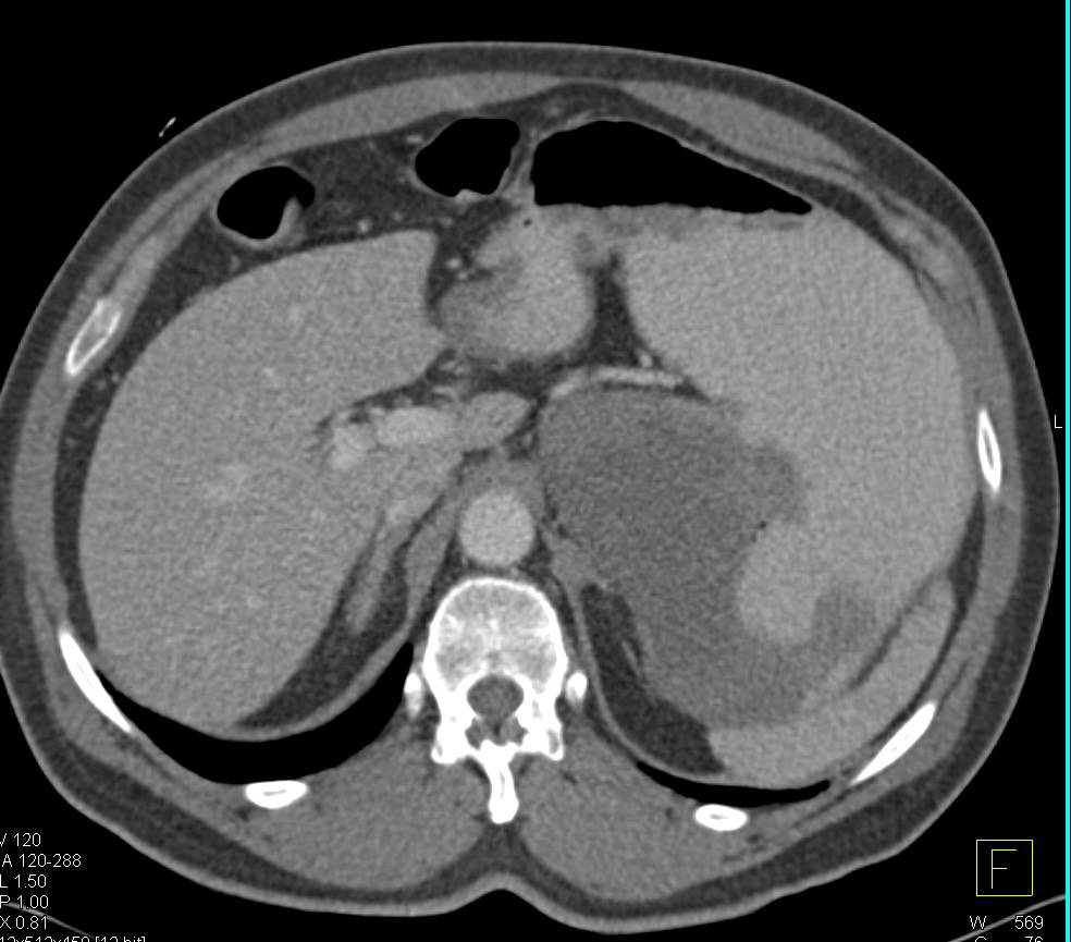 Ulcerating Gastric GIST Tumor - CTisus CT Scan