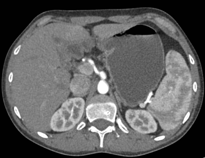 Vascular Mapping of Root of Mesentery - CTisus CT Scan