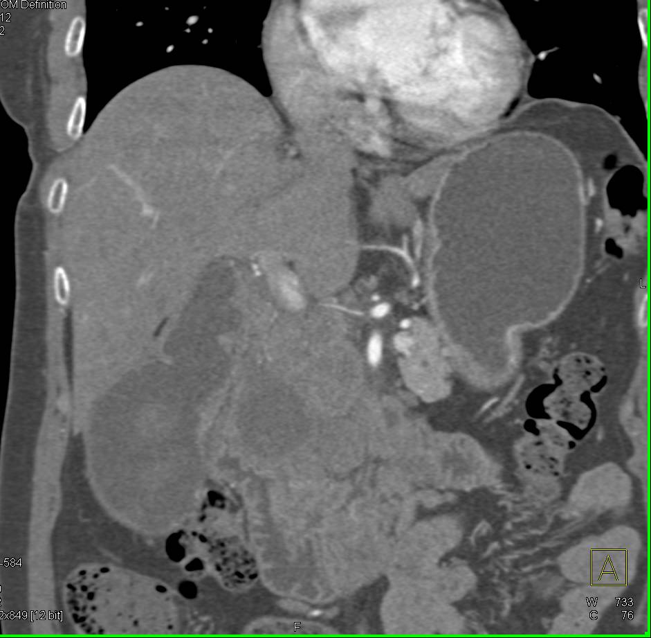 Gallblader Cancer with Portocaval Adenopathy - CTisus CT Scan