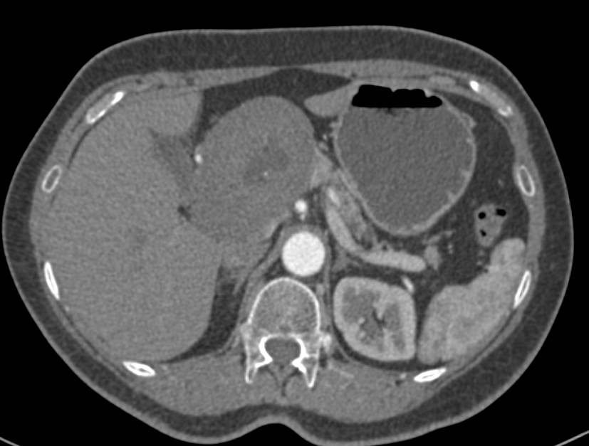 Ganglioneuroma Near the Head of the Pancreas - CTisus CT Scan