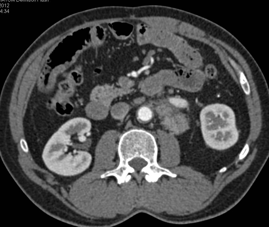 Neuroendocrine Tumor in the Left Para-Aortic Zone - CTisus CT Scan