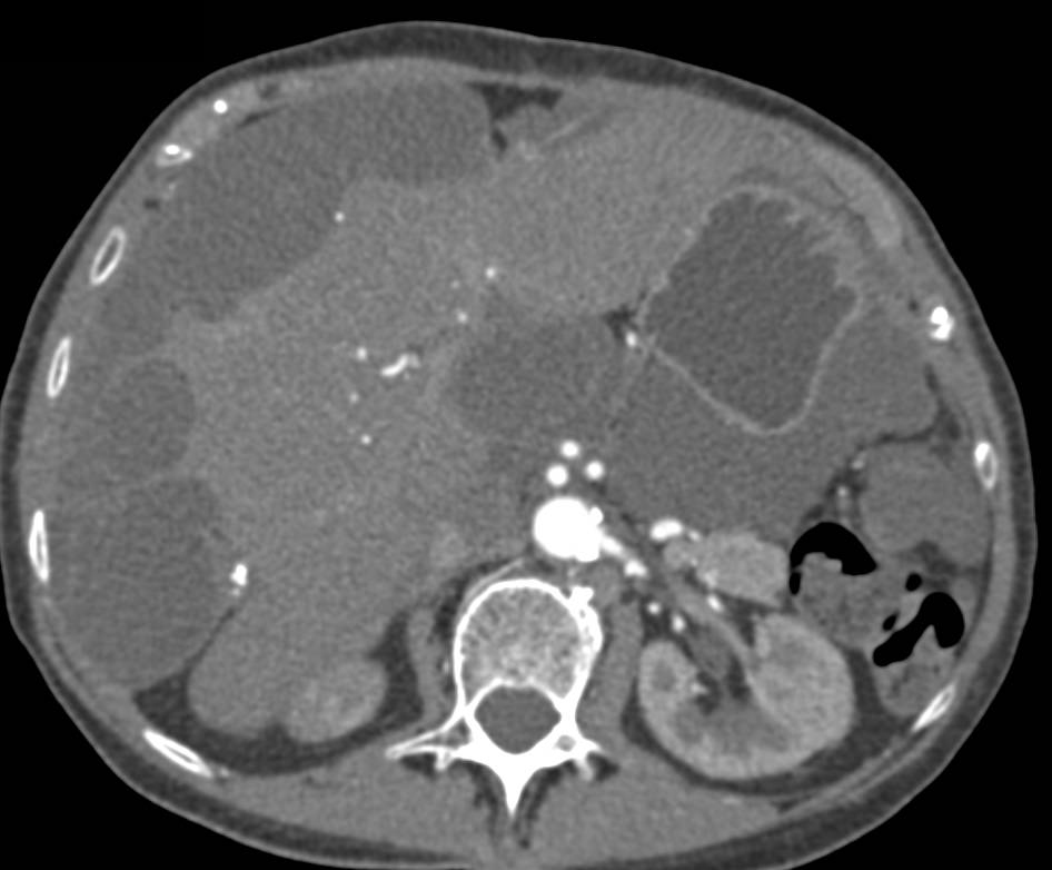 Classic Pseudomyxoma Peritonei (PMP) - CTisus CT Scan