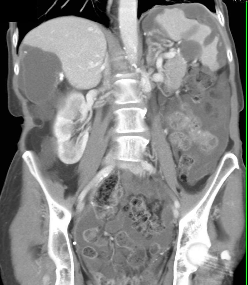 Classic Example of Pseudomyxoma Peritonei (PMP) - CTisus CT Scan