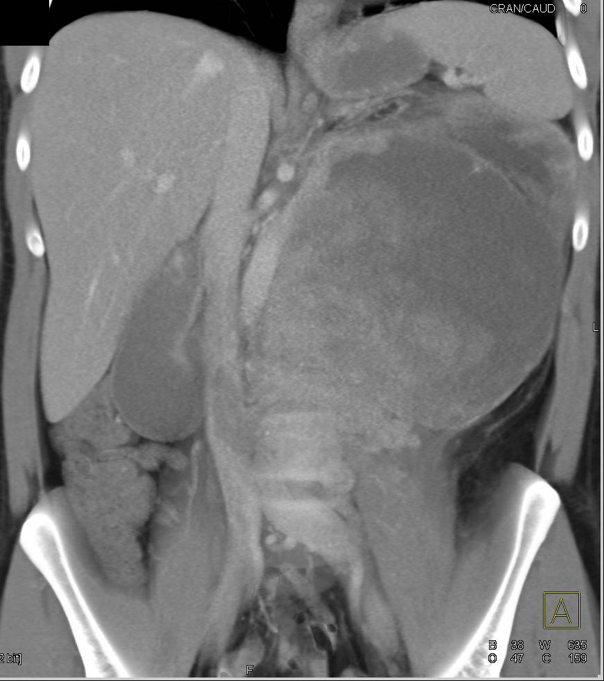 Retroperitoneal Liposarcoma with Minimal Macroscopic Fatty Elements - CTisus CT Scan