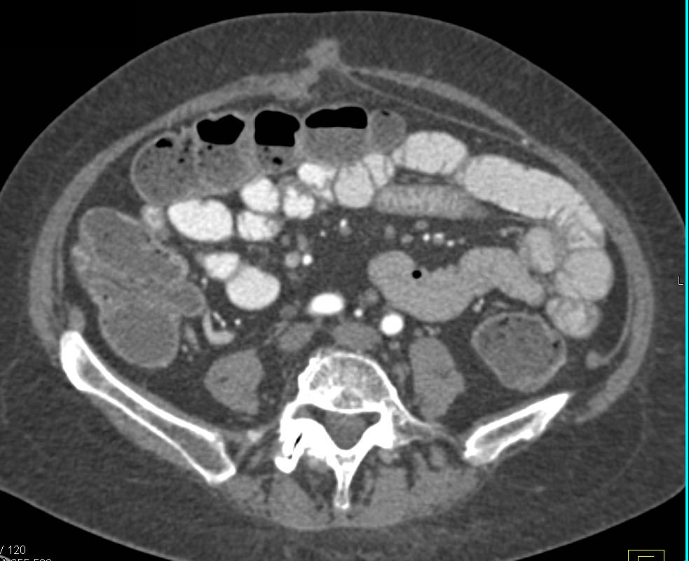 Crohn's Disease with Thick Bowel--- LLQ - CTisus CT Scan