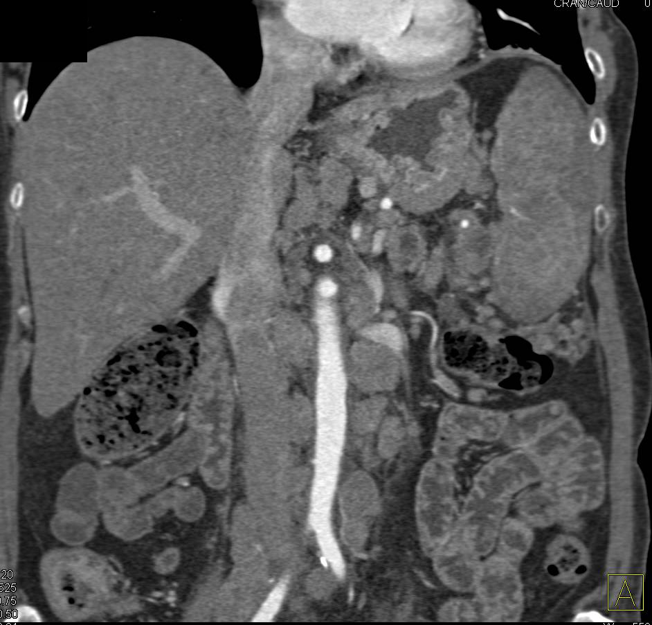 Neuroendocrine Tumor with Bulky Adenopathy and Splenic Involvement Simulates Lymphoma - CTisus CT Scan