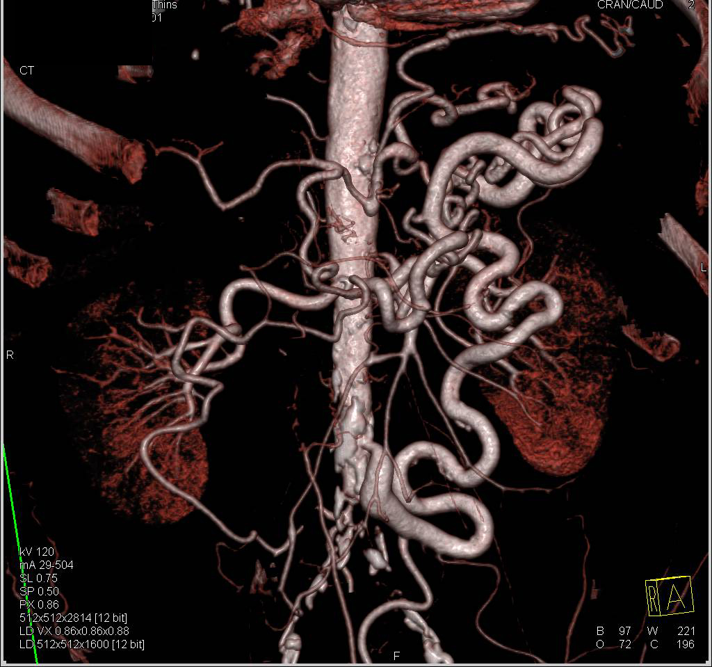 Superior Mesenteric Artery (SMA) and Celiac Occlusion with Graft off Aorta to Supply the Vessels Distally - CTisus CT Scan