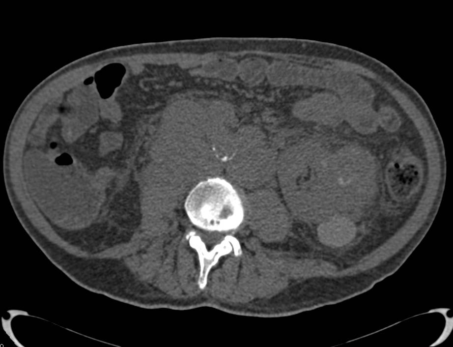 Lymphoma with Bulky Paraaortic Adenopathy - CTisus CT Scan