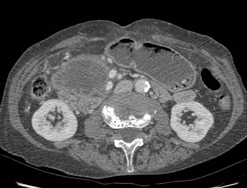 Hematoma Near Pancreatic Bed - CTisus CT Scan