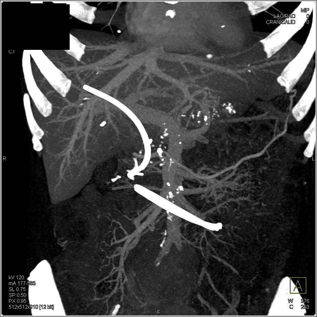 Broken Catheter in Small Bowel - CTisus CT Scan