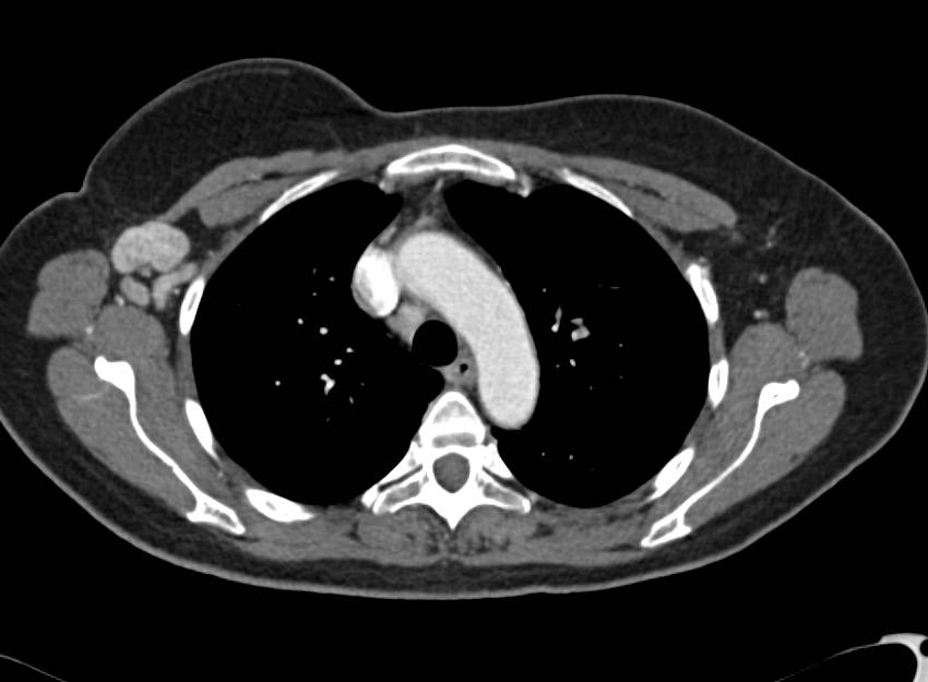 Metastatic Melanoma with Adenopathy and Bone Lesions. Adenopathy Simulates a Pancreatic Mass - CTisus CT Scan