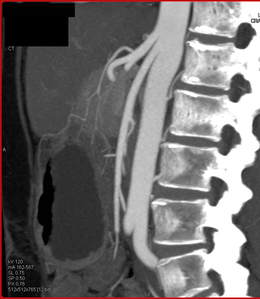 Superior Mesenteric Artery (SMA) Syndrome with Renal Vein Compression - CTisus CT Scan