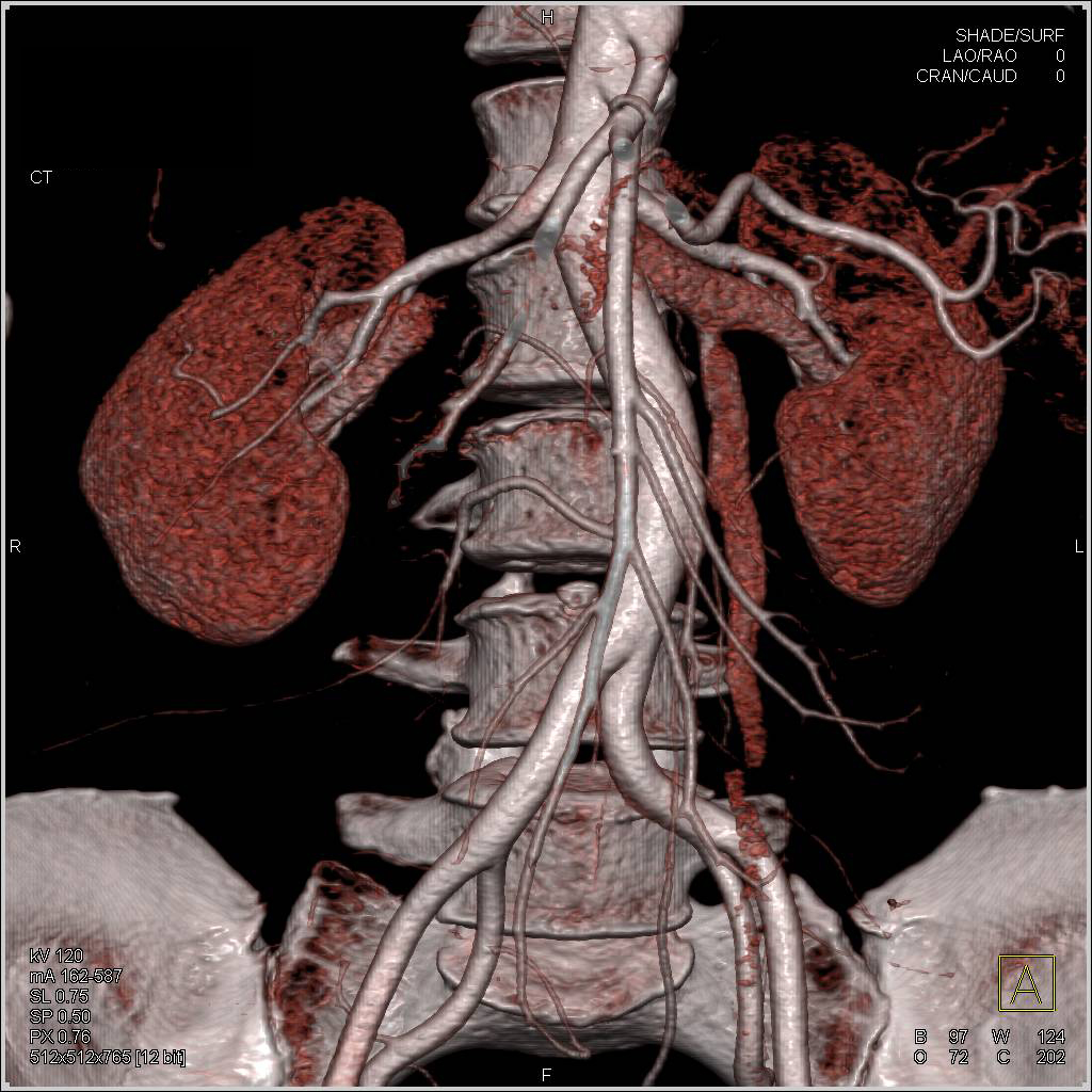 SMA Syndrome with Renal Vein Compression - Gastrointestinal Case ...