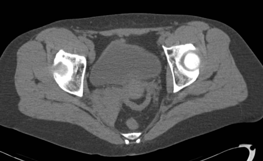 Neurogenic Tumor in Right Ischiorectal Fossa - CTisus CT Scan