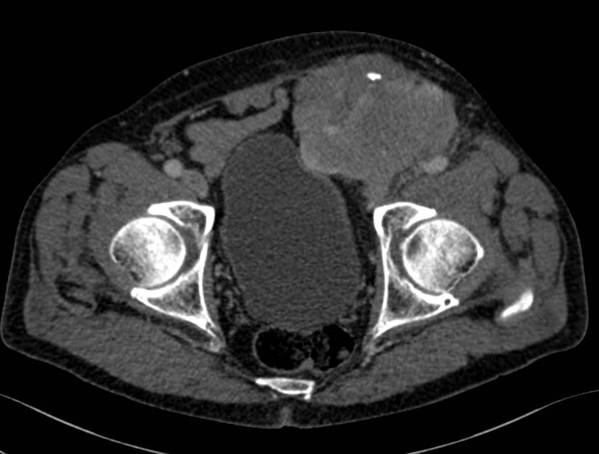 Sarcoma in Left Groin and Inguinal Zone - CTisus CT Scan