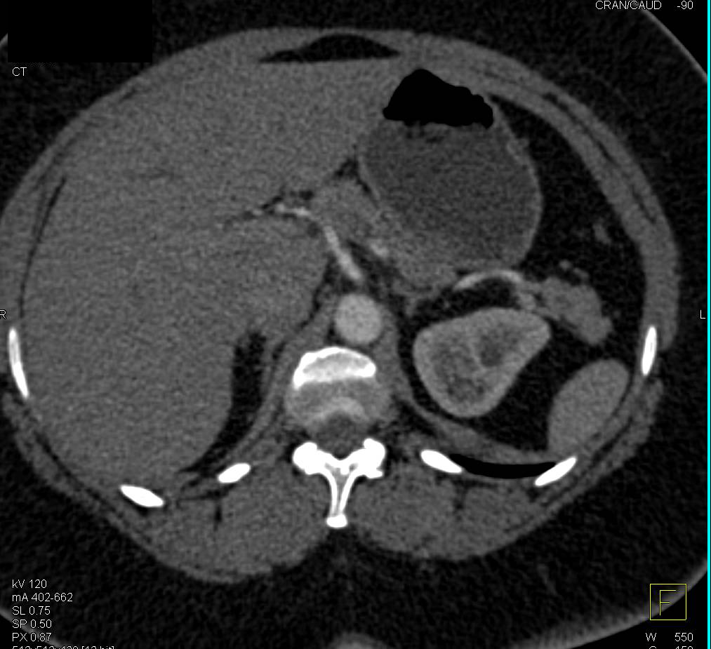 Normal MPR of the Retroperitoneum - CTisus CT Scan