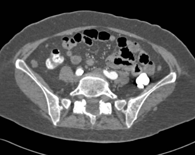 Metastatic Melanoma with Widespread Metastases Including Liver, Small Bowel and Chest - CTisus CT Scan