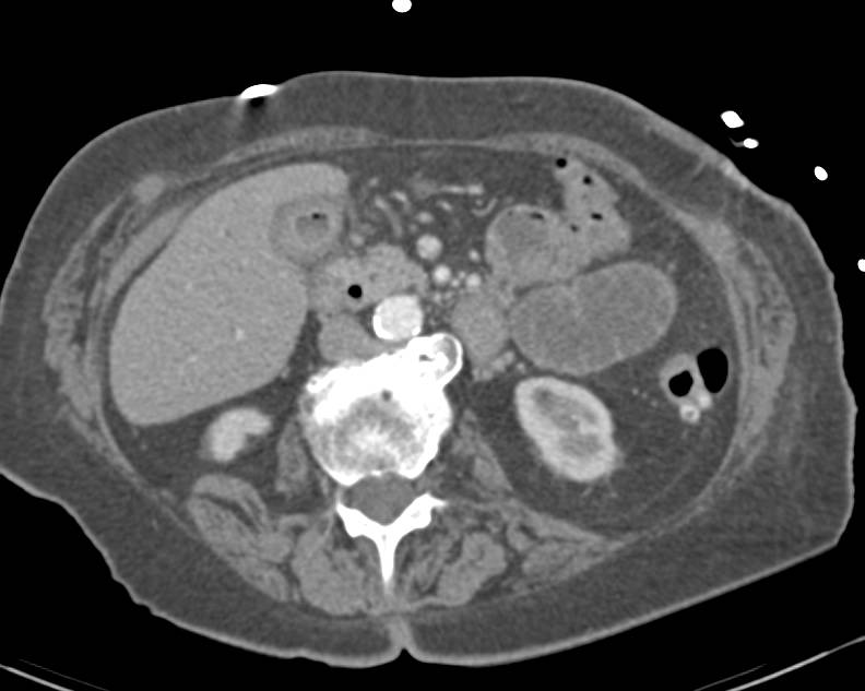 Air in Gallbladder Consistent with Infection - CTisus CT Scan