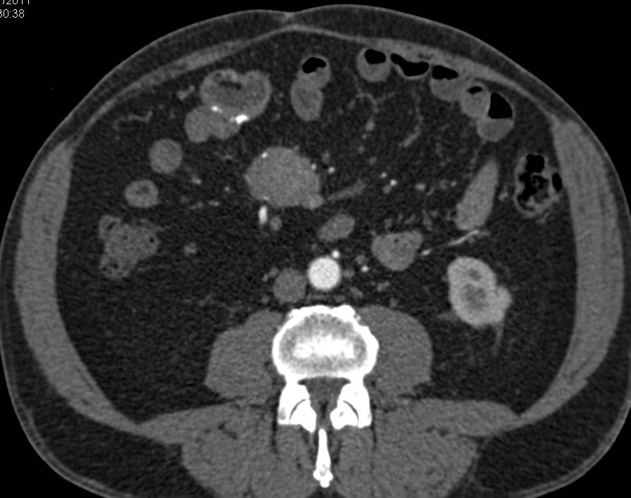 Carcinoid Tumor Encases the Superior Mesenteric Artery (SMA) in the Root of the Mesentery - CTisus CT Scan