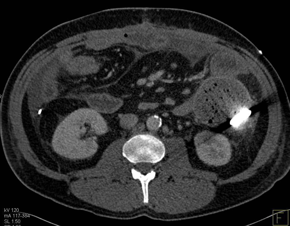 Retained Sponge in Left Upper Quadrant Easy to see on Topogram - CTisus CT Scan