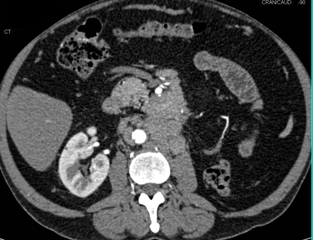 Lymphoma with Adenopathy and Pancreatic involvement - CTisus CT Scan