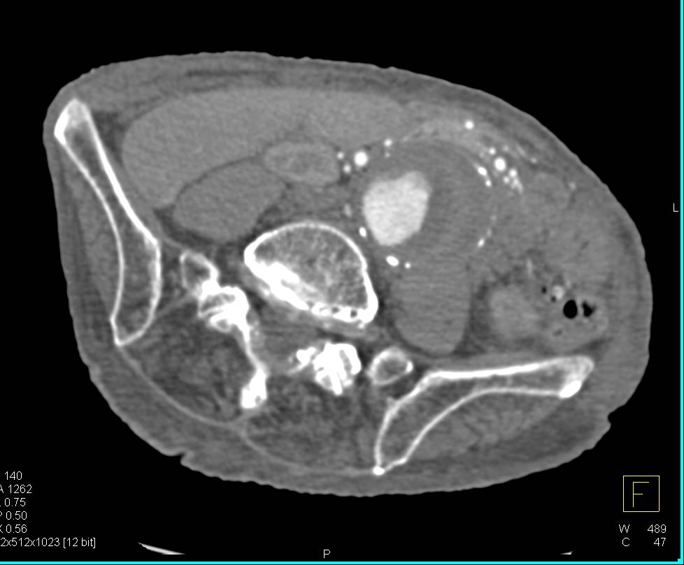 Large Left Flank Hernia - CTisus CT Scan