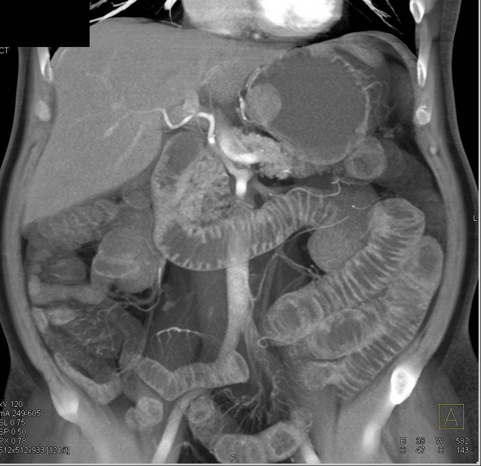 Gastric GIST Tumor - CTisus CT Scan