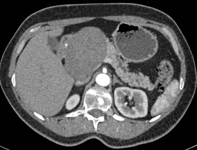 Paraganglioma Simulates a Pancreatic Mass - CTisus CT Scan