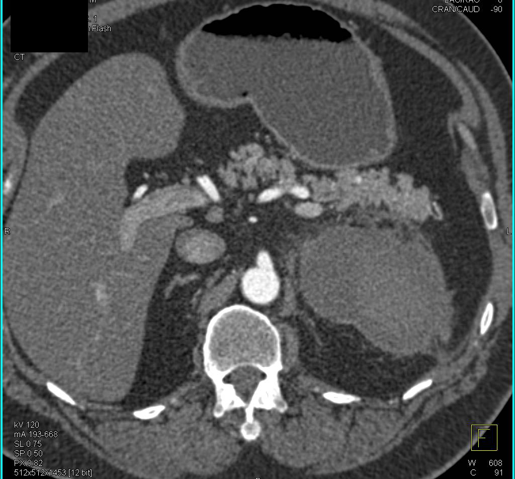 Hematoma Near Pancreas and Kidney - CTisus CT Scan