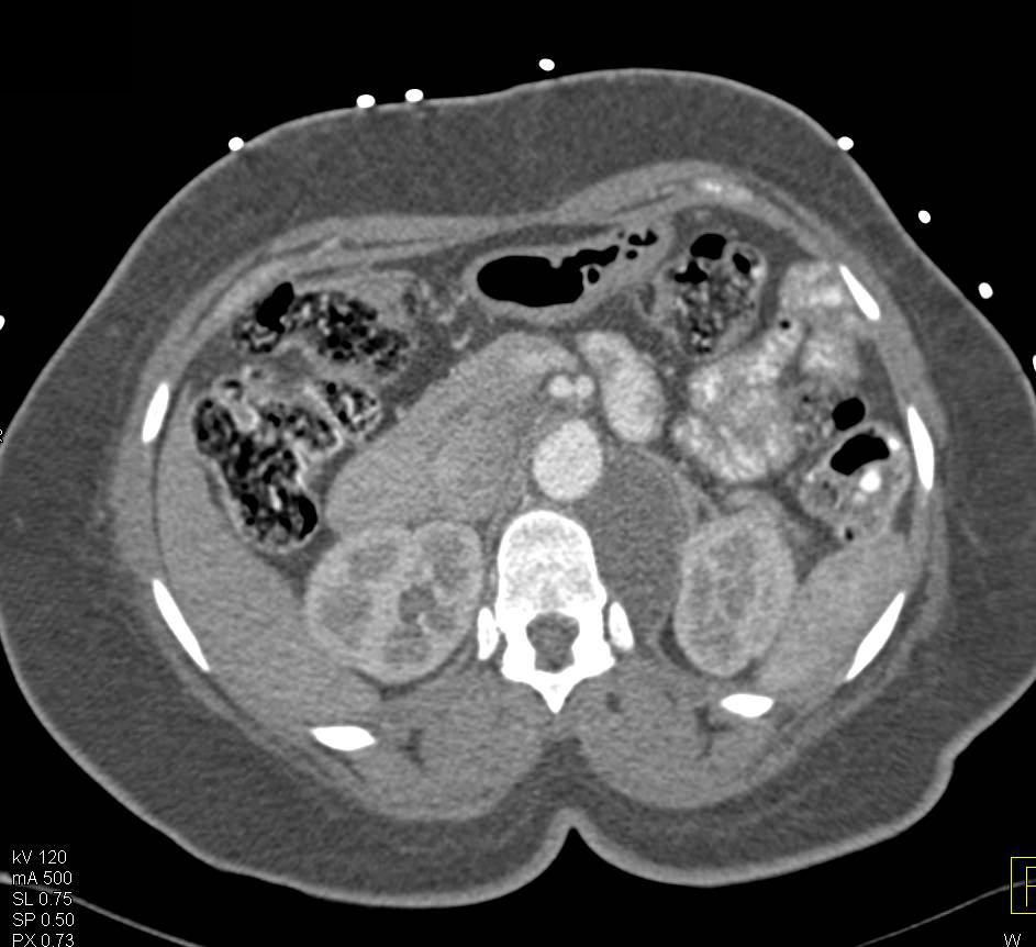 Neurogenic Tumor in Paraspinal Zone - CTisus CT Scan