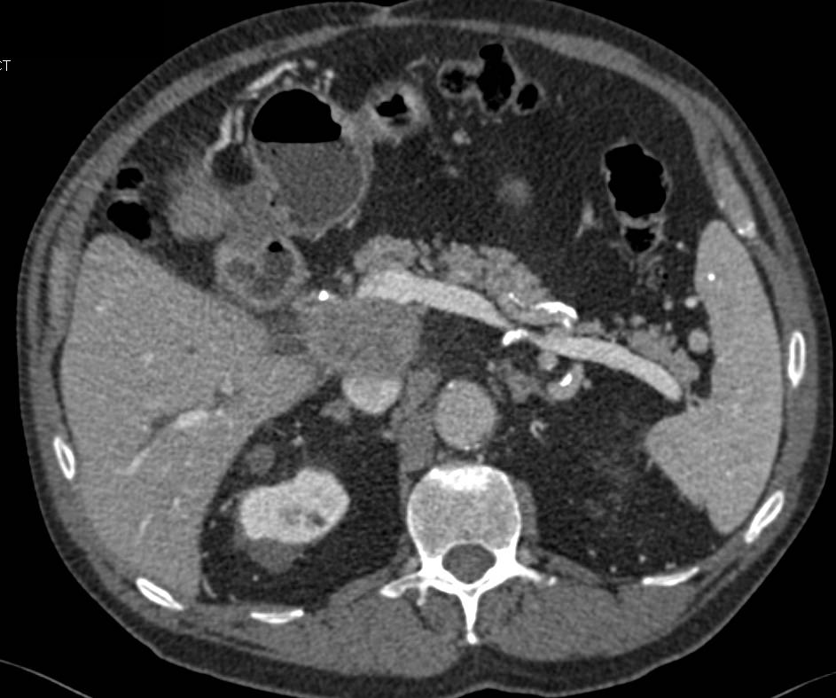 Duodenal Cancer with Polypoid Lesions and Portocaval Adenopathy - CTisus CT Scan