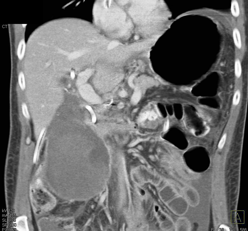 Distended Gallbladder with Questionable Fistulae - CTisus CT Scan