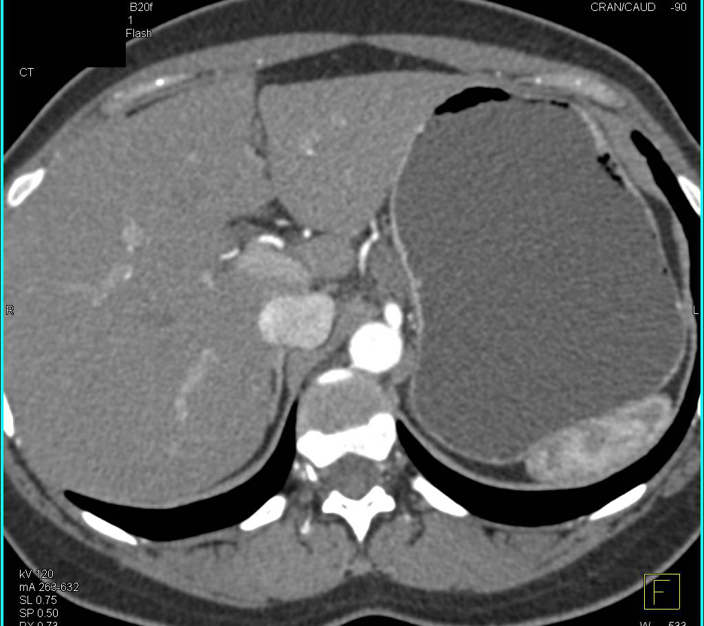 Enlarged Celiac Adenopathy - CTisus CT Scan