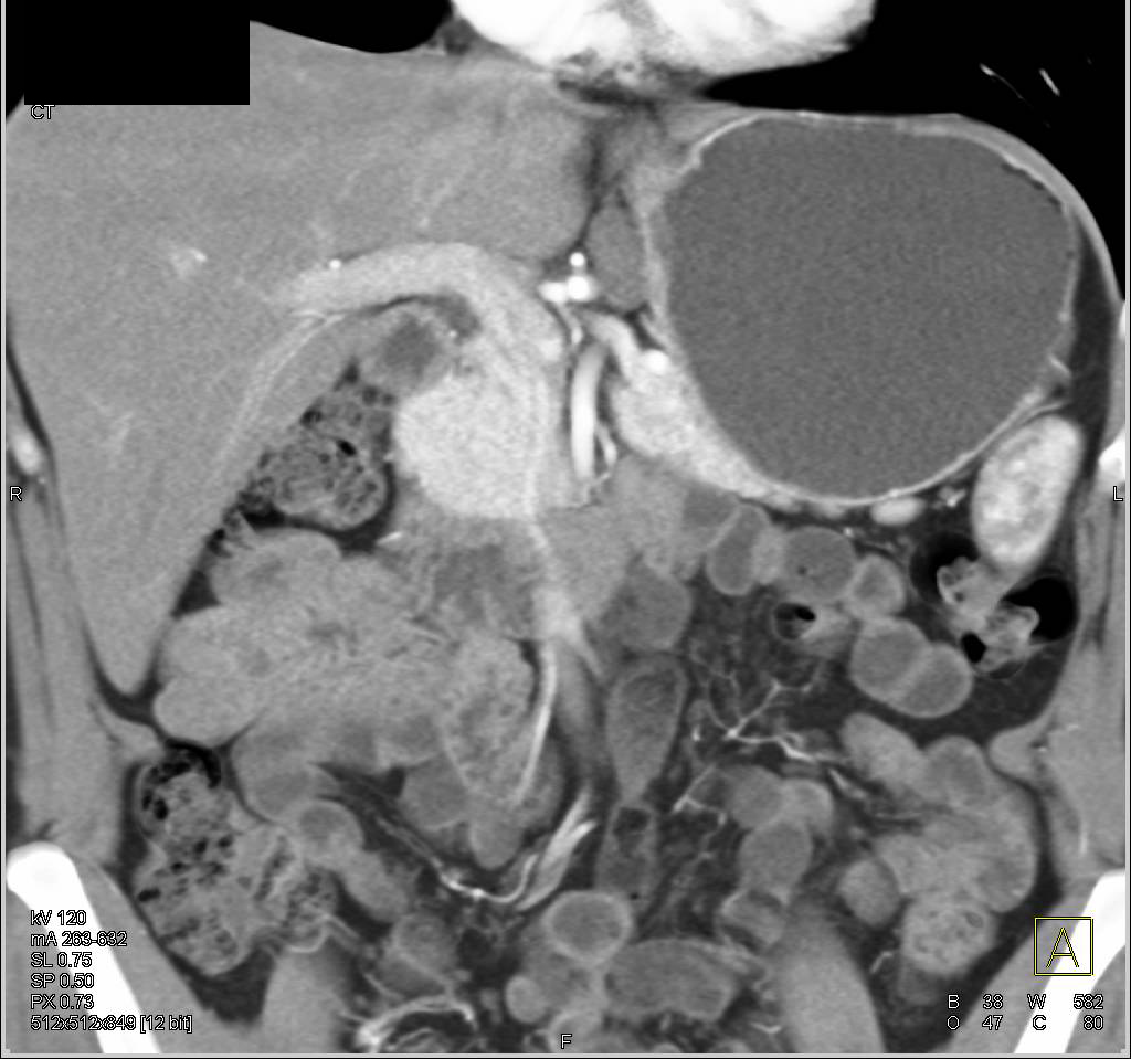 Neurogenic Tumor in Region of Celiac Nodal Chain - CTisus CT Scan