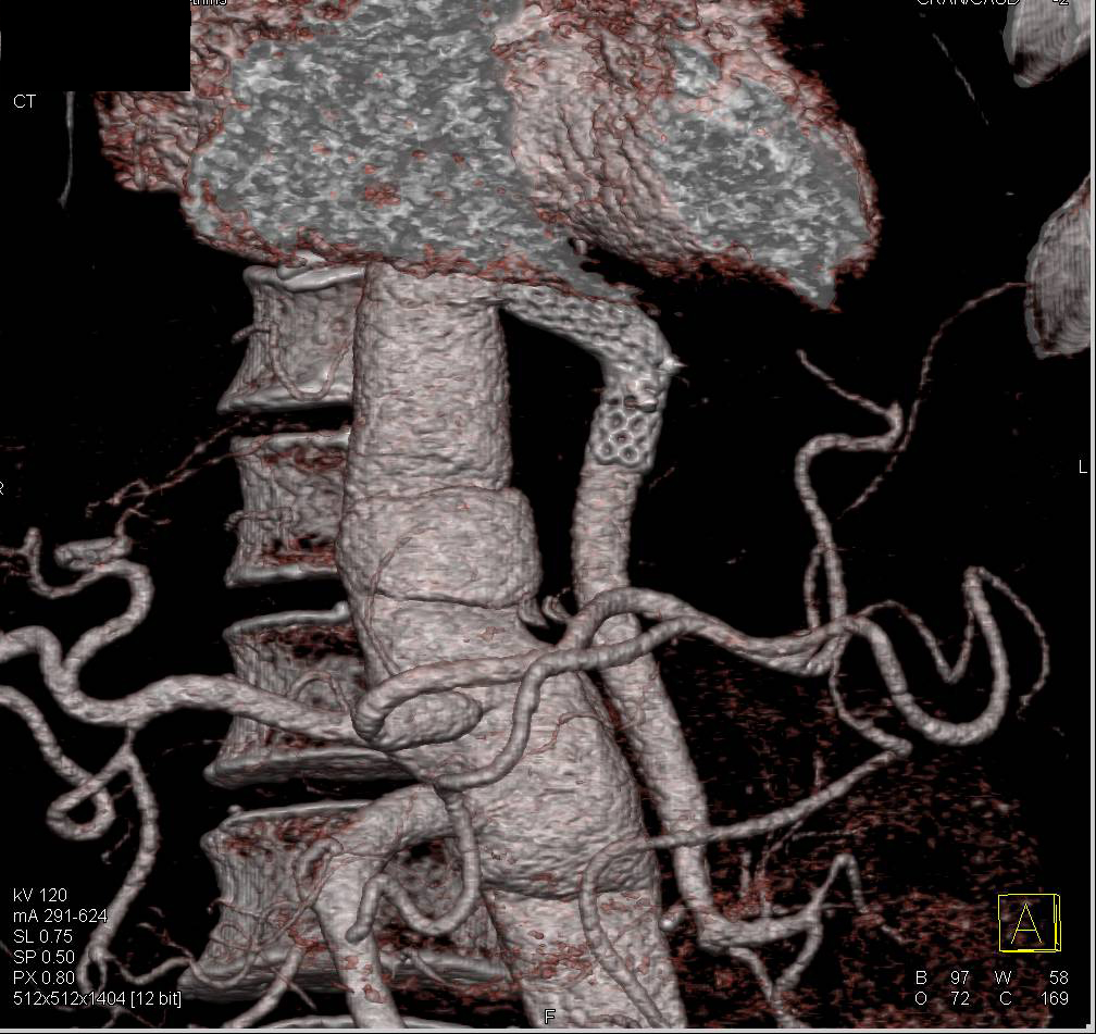 Vascular Repair with Multiple Stents - CTisus CT Scan