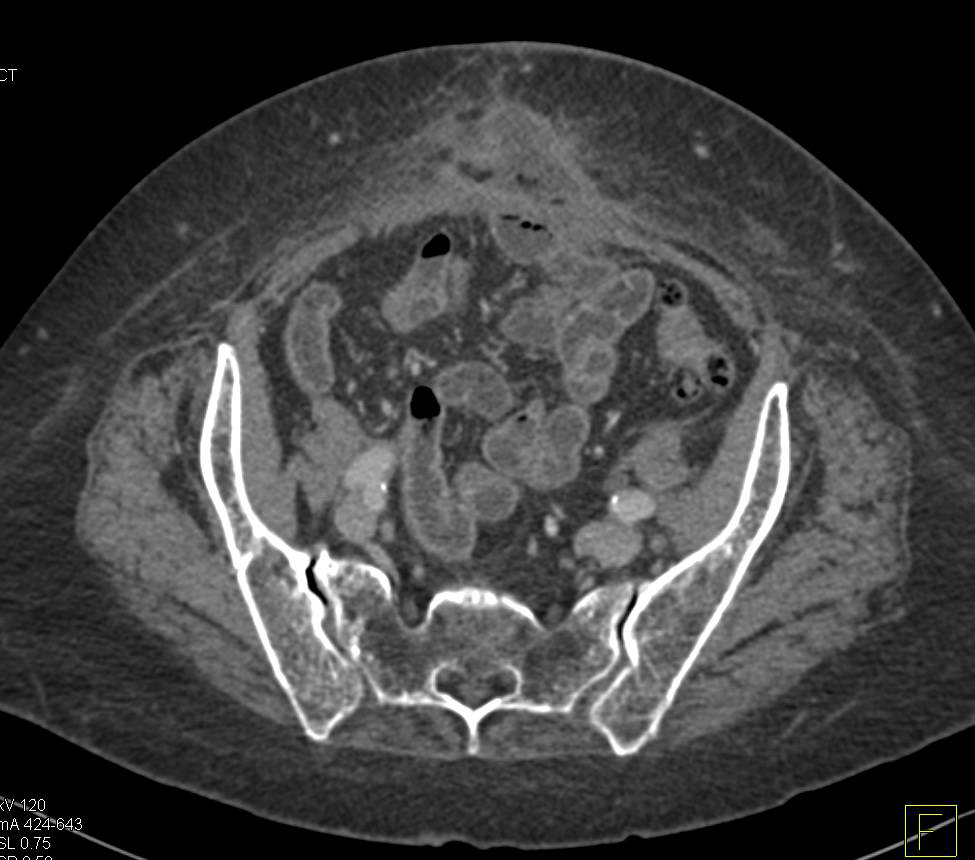 CT Defines Enterocutaneous Fistulae (ECF) - CTisus CT Scan