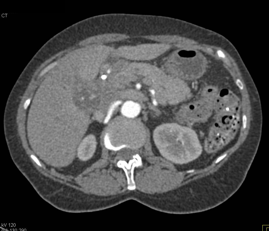 Gallbladder Cancer - Gastrointestinal Case Studies - CTisus CT Scanning