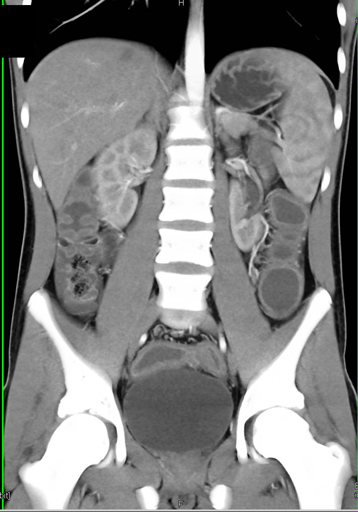 Ulcerative Colitis - Gastrointestinal Case Studies - CTisus CT Scanning